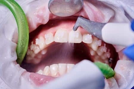 Parodontosebehandlung